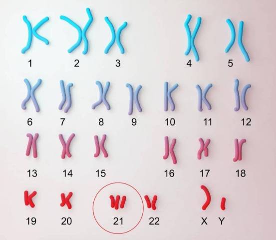 Fiche d�pistage Trisomie 21